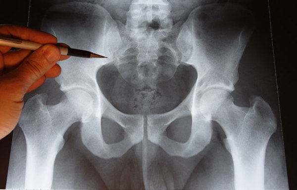 рентген - доступный метод диагностики воспаления седалищного нерва